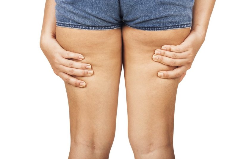 Mga sanhi ng hitsura ng cellulite