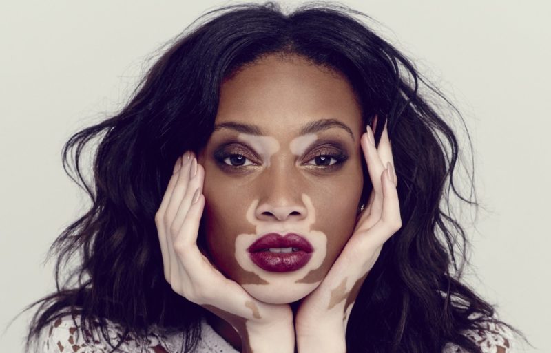 Fille avec le vitiligo sur son visage.