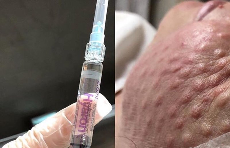 Ang mga pagbawas ng dermal infiltrates kaagad pagkatapos ng pangangasiwa ng droga