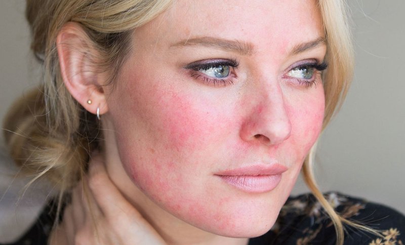 Maladie dermatologique sur le visage