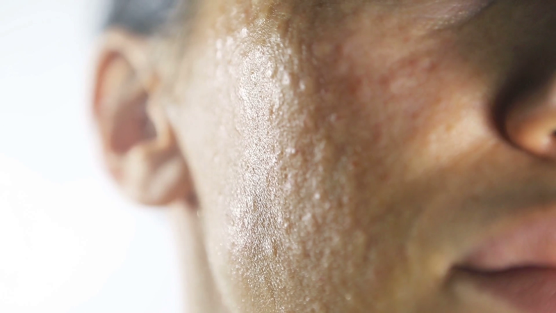 Papules d'un diamètre de 1 mm sur la face