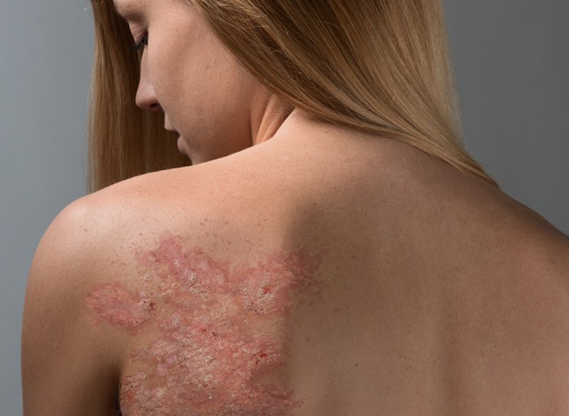 Le psoriasis sur le corps