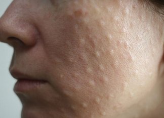 Papules après bio-revitalisation