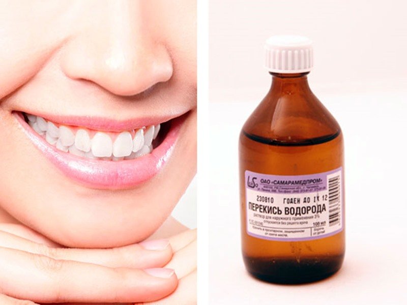 Peroxide Teeth Whitening