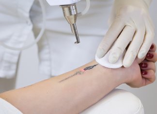 Ang pagtanggal ng tattoo ng laser